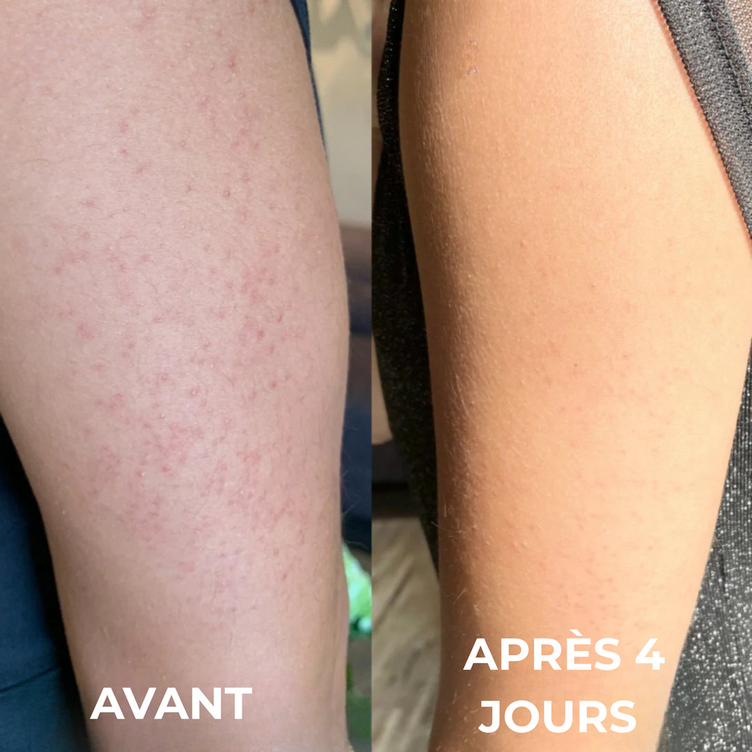 Strawbeauty - la solution contre la kératose pilaire.